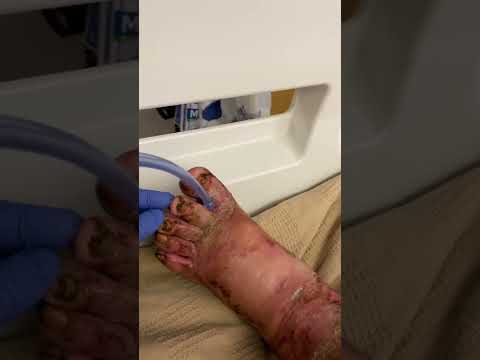 Maggot foot