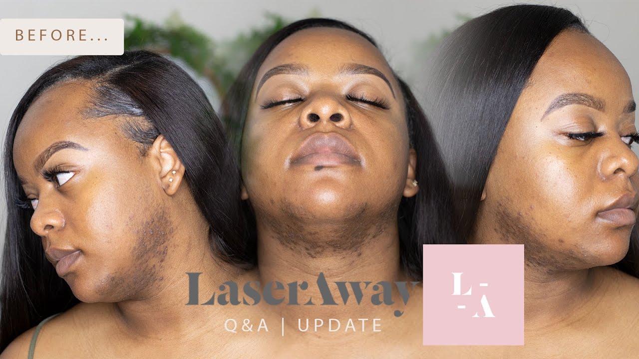 FACIAL HAIR REMOVAL Q&A, UPDATE + LASER AWAY REVIEW Just Grvce YouTube