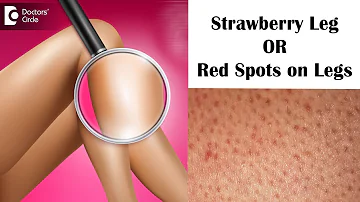 Strawberry leg | Red Bumps and Spots on Legs - Dr. Rashmi Ravindra |Doctors' Circle