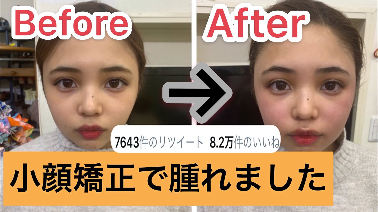 Twitterで8万いいね 小顔矯正で腫れました Youtube