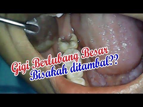 Video Mematikan Saraf Gigi Yang Sering Sakit