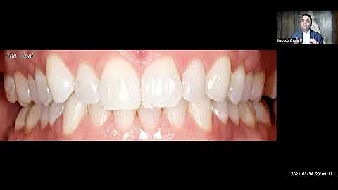 Dr. Sundeep Rawal Implant Webinar - Aspen Dental 0...