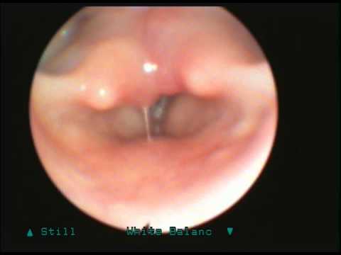 Vocal cord immobility after intubation