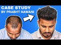 Case Study : Best Hair Transplant Result After 6 Months Without Temple Creation And Good Donor Area