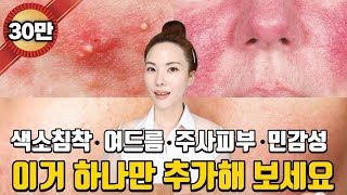 [13] ENG) 여드름, 홍조, 주사피부염, 민감피부, 기미까지 도저히 개선이 안되시나요? 나이아신아아미드를 꼭 추가하세요. 6가지 피부타입별 제품 추천까지!!