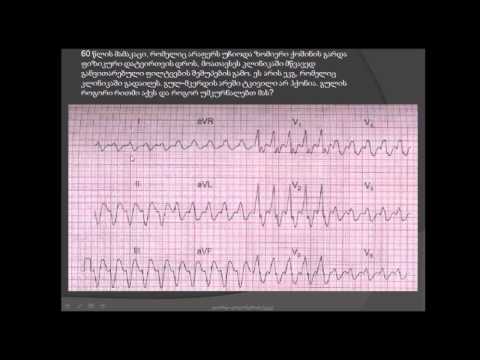ეკგ / ფართოკომპლექსიანი ტაქიკარდია / ფილტვების შეშუპება / ელექტრული კარდიოვერსია / დიამორფინი