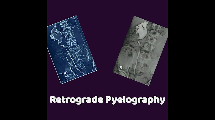 Cystoscopy with retrograde pyelogram and stent placement cpt