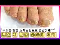 5분만에 무좀 파헤치기!! 무좀의 원인, 관리방법 상세히 알려드립니다! (Fungal toenail)