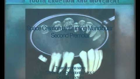 Clip 50: Space Creation by Erupting Mandibular Second Premolar