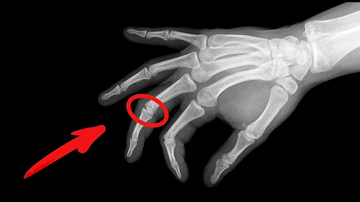Why a man cracked the knuckles of his left hand for 50 years - DayDayNews