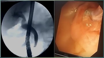 ERCP PLASTIC STENT REMOVAL #BD_ENDOSCOPY
