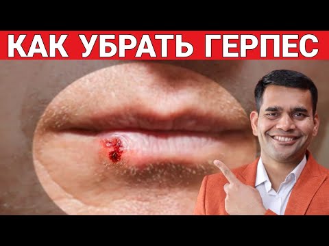 Избавьтесь От Герпеса | Попробуйте Это, Если Вы Страдаете От ГЕРПЕСА- Доктор Вивек