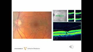 16 Macular Hole