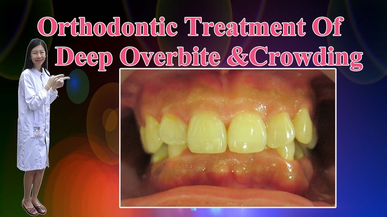 Orthodontic Treatment Of Deep Overbite & Crowding YouTube