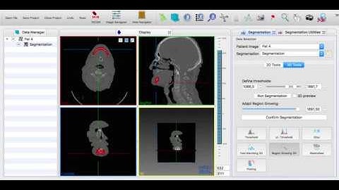 MITK Region Growing 3D Tutorial Video for Mandibular / Lower Jawbone Segmentation