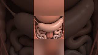 Appendicitis How The Appendix Gets Inflamed