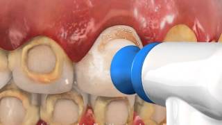 Decalcification