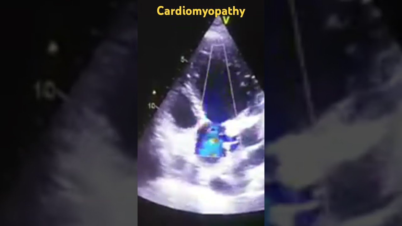 Assessing LV function in presence of DCMP...