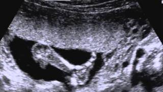 Ecografia 17 settimana di gravidanza commentata screenshot 5