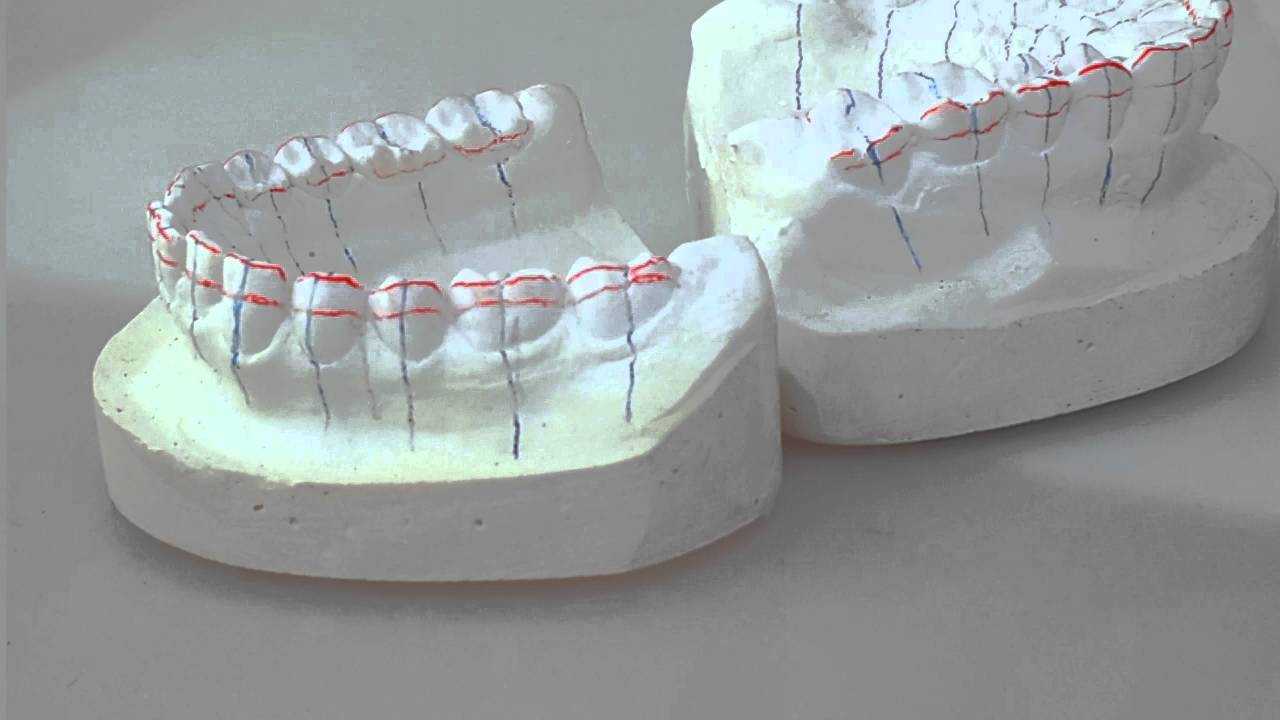 The story of an orthodontic setup! YouTube