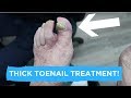 HOW TO TREAT A THICK TOENAIL & OUR HOLIDAY VLOG!!