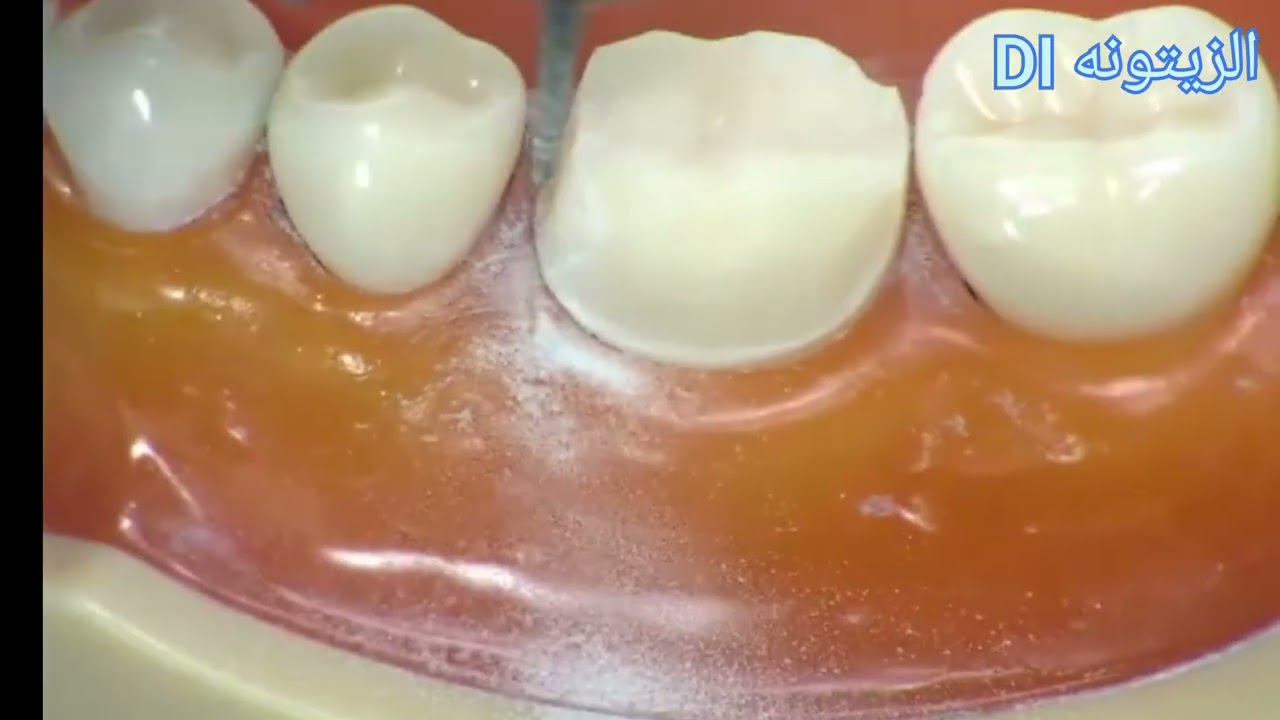 Preparation for all metal  ردكشن reduction  lower 6