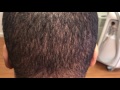 African-American Post-FUE Donor Evaluation