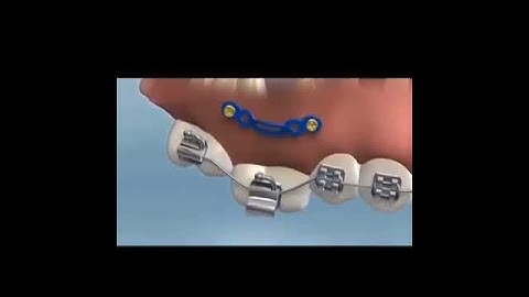 Orthodontic Anchor Mini Screw