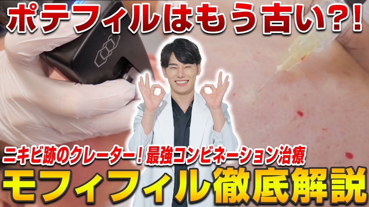 ニキビ跡のクレーター治療で話題！ポテフィルの上位互換？！モフィフィルについてお話します。
