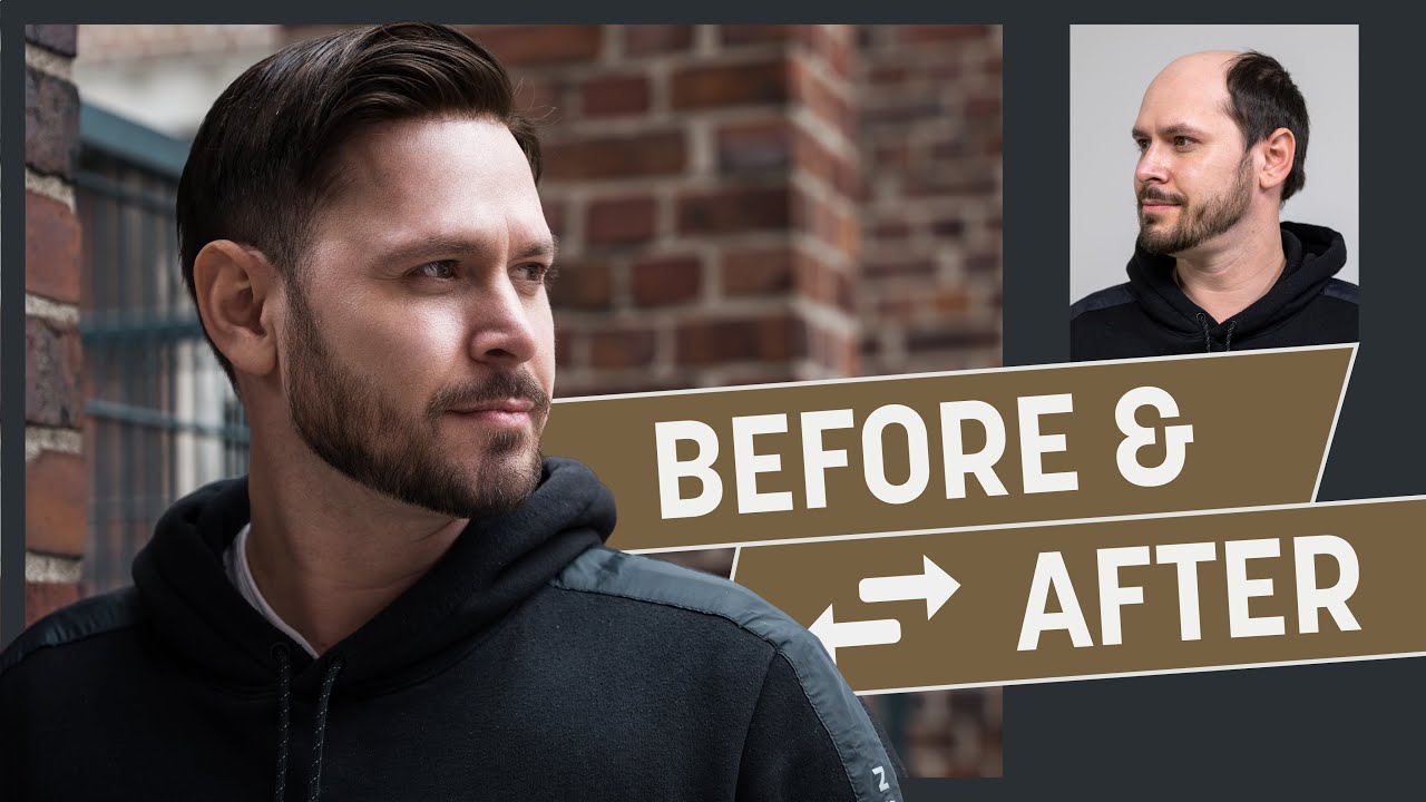 More confident with a hair system? How to look young again with a hairpiece