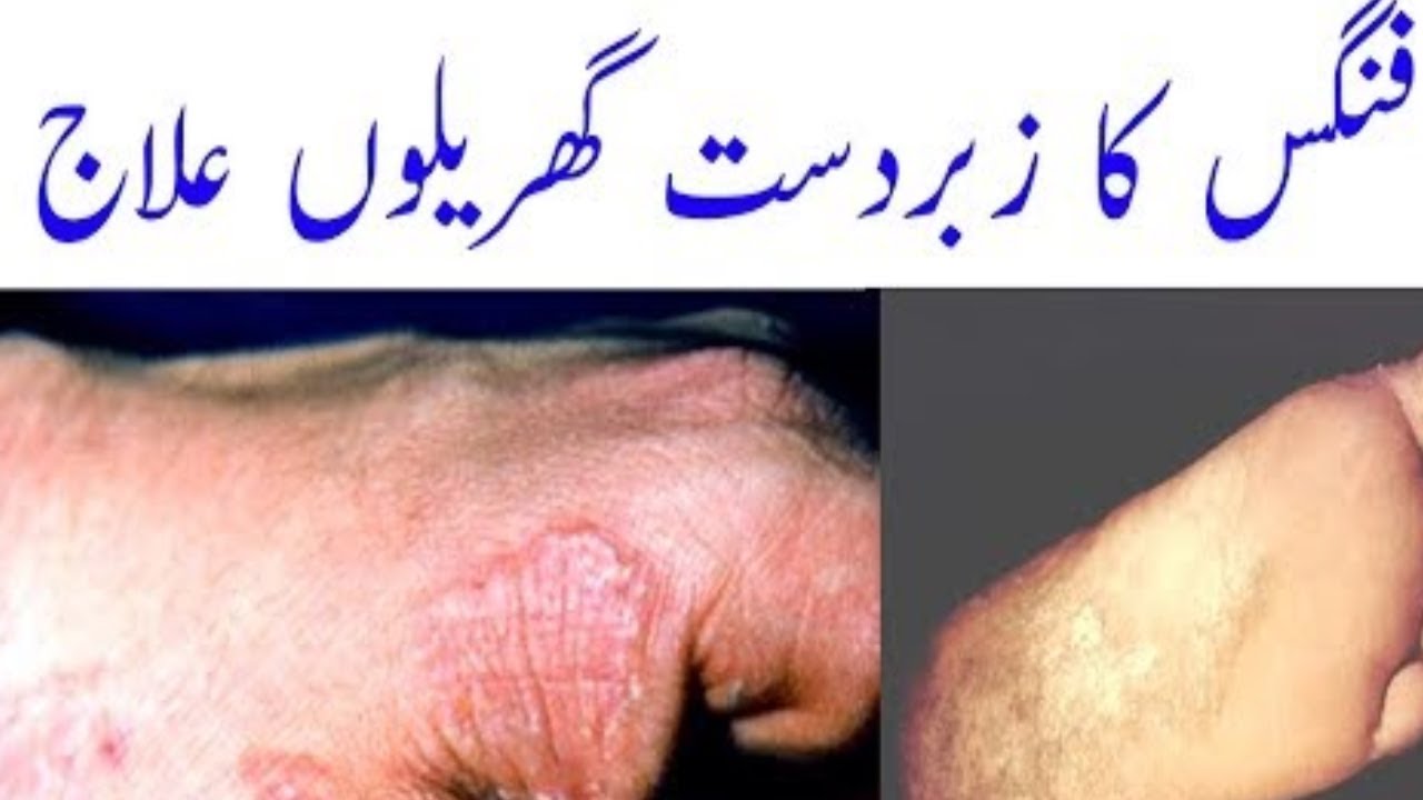 fungal infection home treatmentherbal remedy for fungus infection