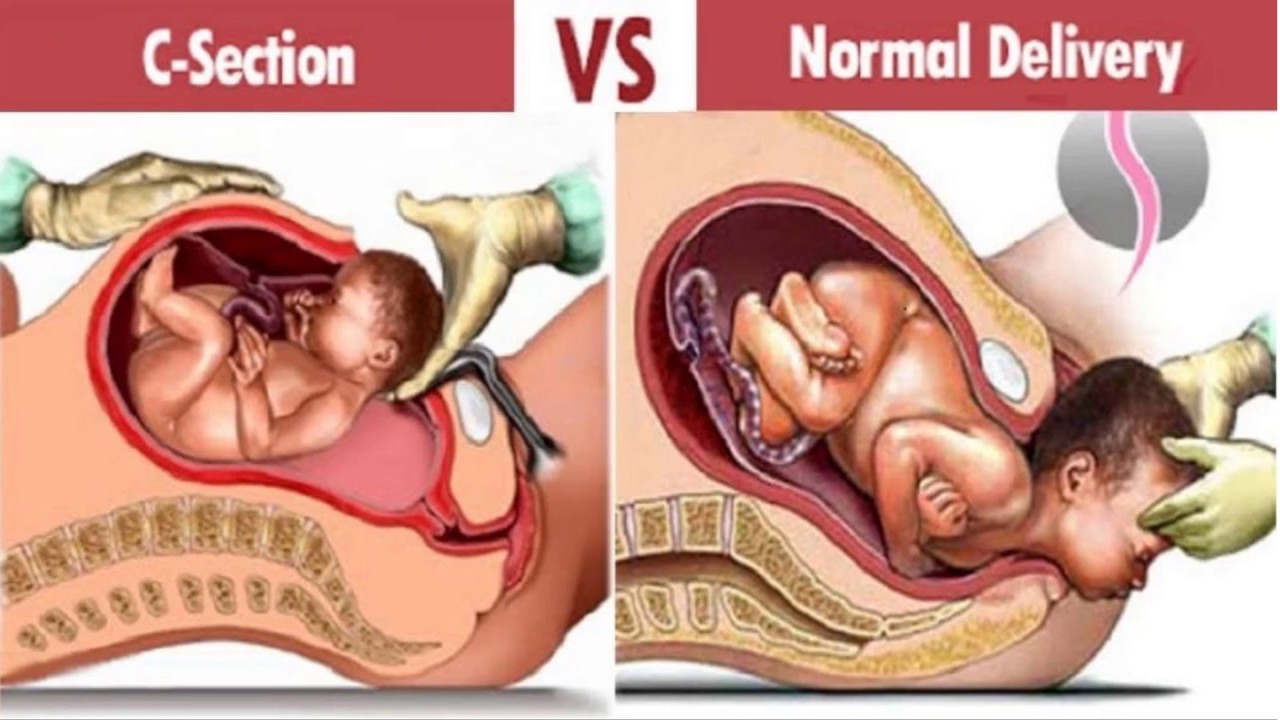 Understanding factors leading to primary cesarean section and vaginal birth after cesarean delivery in the friuli