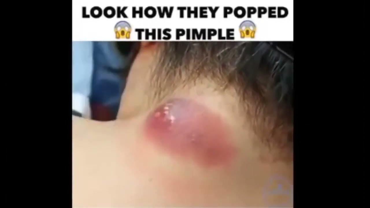 Popping Huge Boils And Cysts At Home carbuncle infected satisfying cyst and boil popping compilation - YouTube