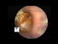 Common cerumen embolism and cholesteatoma reexamination and cleaning,9mins, 20230112