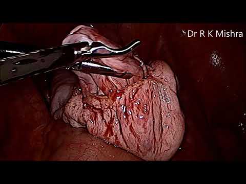 laparoscopic-ovarian-cystectomy-for-large-ovarian-cyst