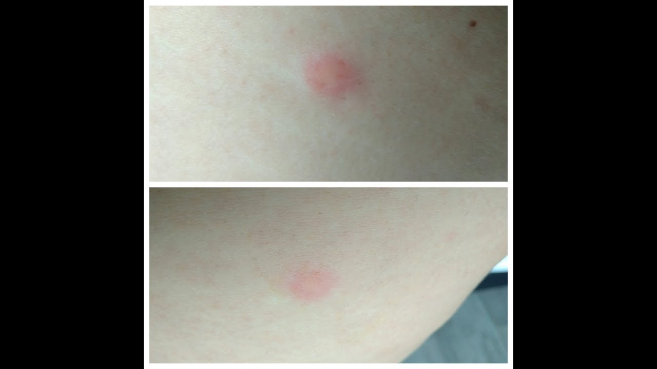 Укусы насекомых и аллергия на лице: необычный способ помочь при укусах ...