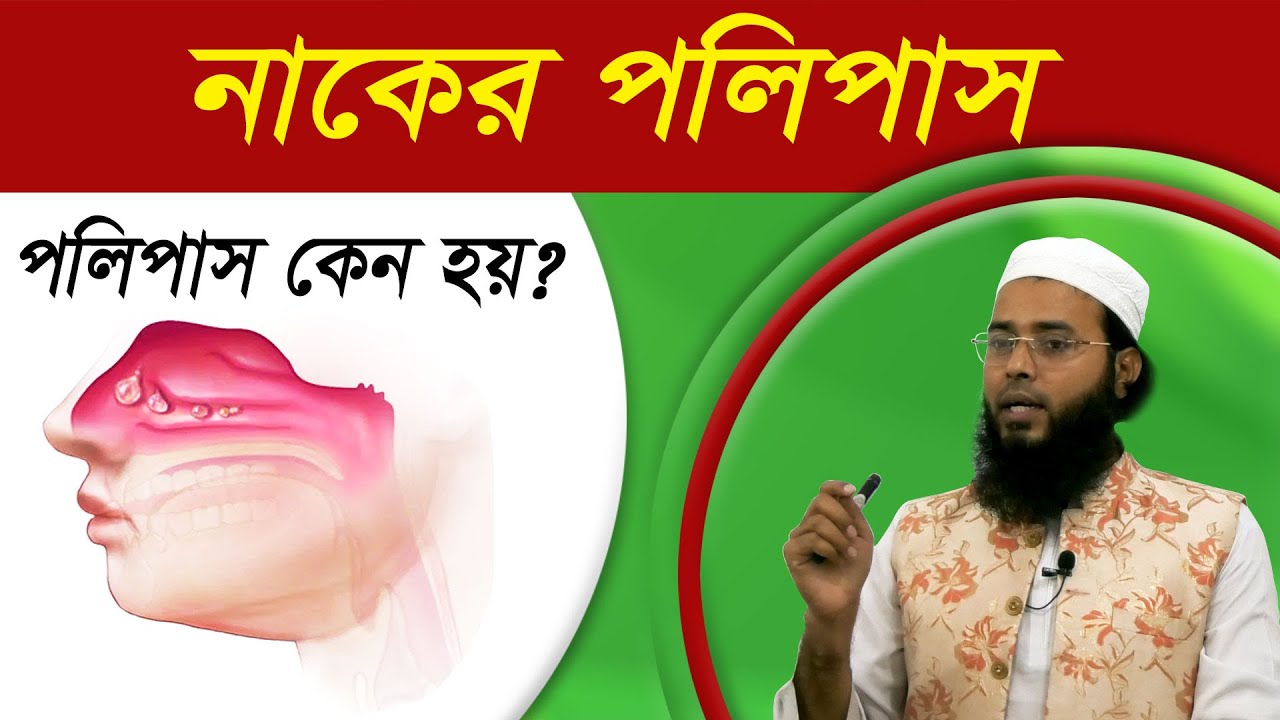 নাকের পলিপাস এর লক্ষণ | পলিপাসের হোমিও চিকিৎসা | হোমিও ঔষধ | Polyps Homeo Medicine | সুস্বাস্থ্য