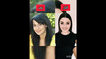 ممثلات تركيات قبل وبعد عملية التجميل 