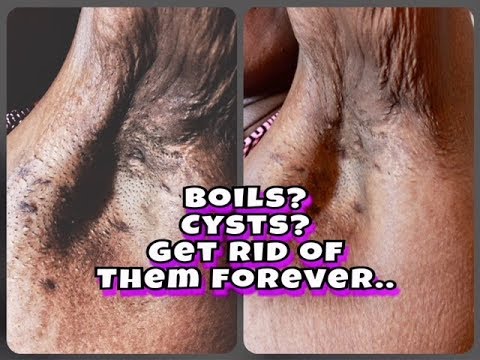 Boils Under Armpits & Inner Thighs - YouTube