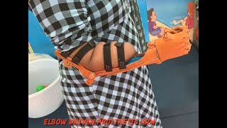 3D PRINTED ELBOW DRIVEN PROSTHESIS