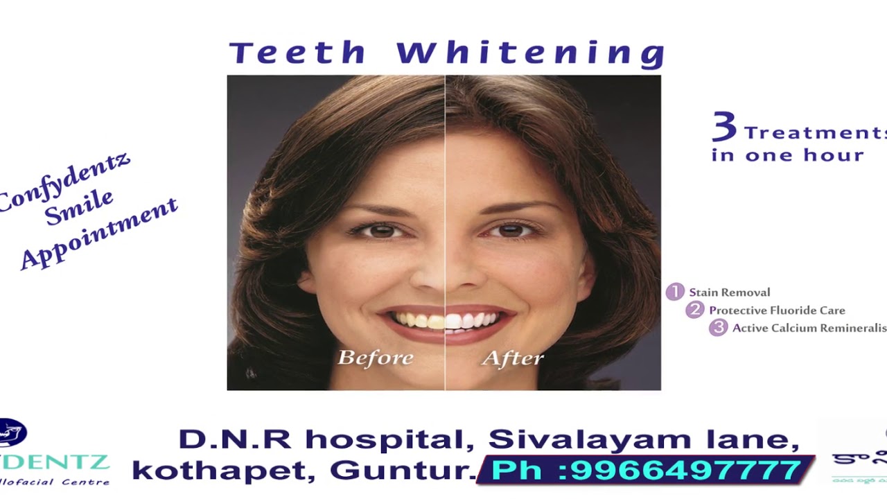 Teeth Whitening in Guntur at Confydentz Dental Hospital YouTube