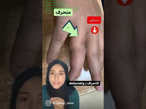 كيف تتعرف على الكسر