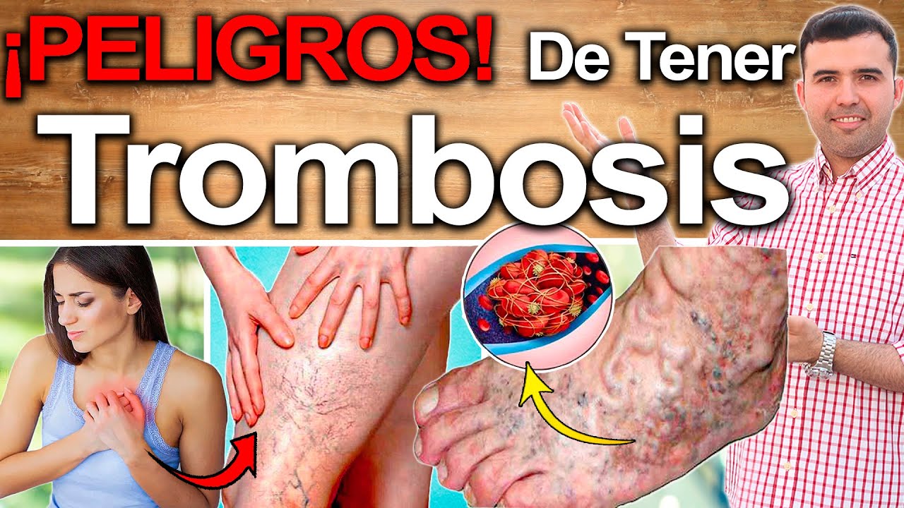 S�ntomas Que Indican Que Tus Venas Est�n Tapadas Y Con Trombos