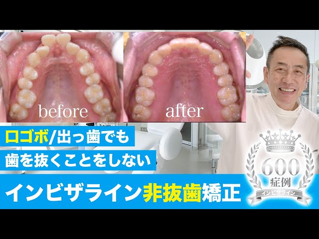 196 非抜歯矯正 sddefault.jpg