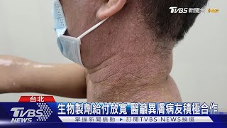 異位性皮膚炎 生物製劑健保給付8/1已放寬｜TVBS新聞