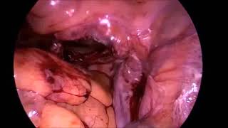 Laparoscopic removal of cervix and US vault suspension