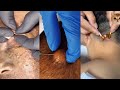 17 minutes popping pimples  removal blackheads and cyst  best pimple popping compilations 9