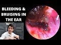 Bleeding and bruising in the ear canal haemoglobin breakdown explained