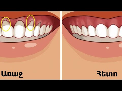 Video: Ատամնաբույժը խոսեց դիմակների ազդեցության մասին ատամների և լնդերի վրա