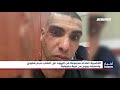 أخبار مساواة الخضيرة اعتداء مجموعة من اليهود على الشاب نديم شتيوي واصابته بجروح من قرية جلجولية أخبار مساواة الخضيرة اعتداء مجموعة من اليهود على الشاب نديم شتيوي واصابته بجروح من قرية جلجولية